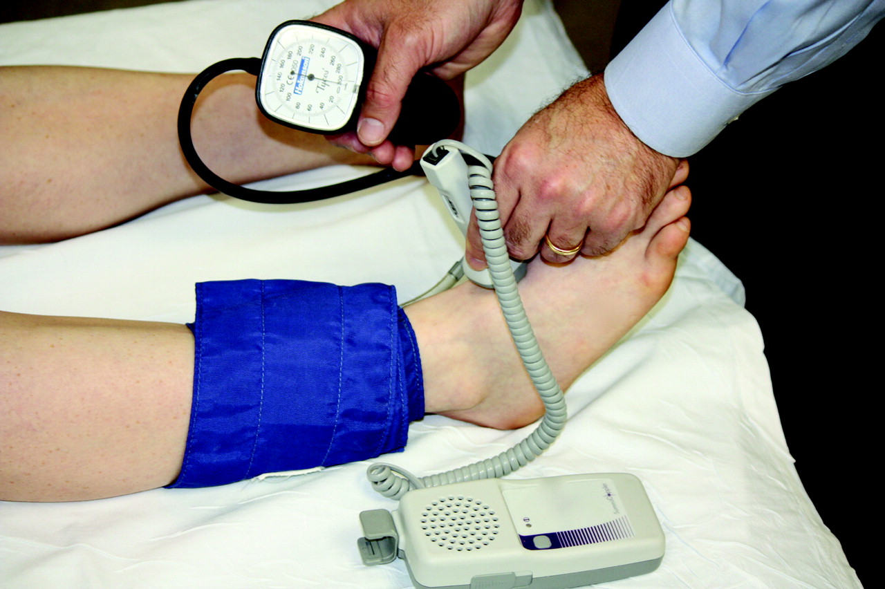 abi blood pressure test